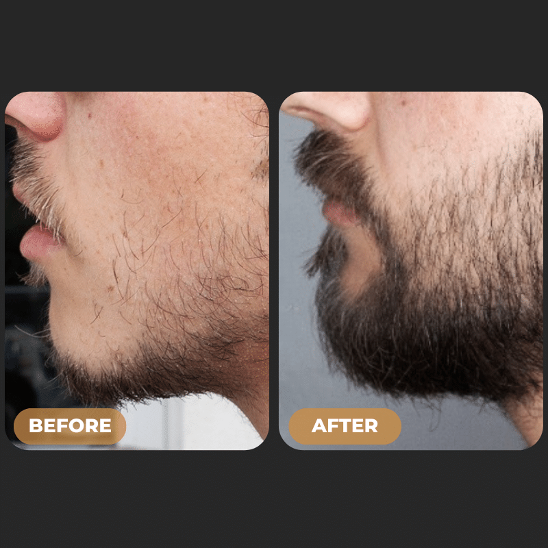 SPARTAN™ - Beard Growth Activator